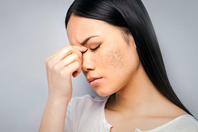 Top 5 cách trị nám, tàn nhang sau sinh an toàn, không ảnh hưởng đến em bé Cách trị tàn nhang cho nam giới sau sinh an toàn