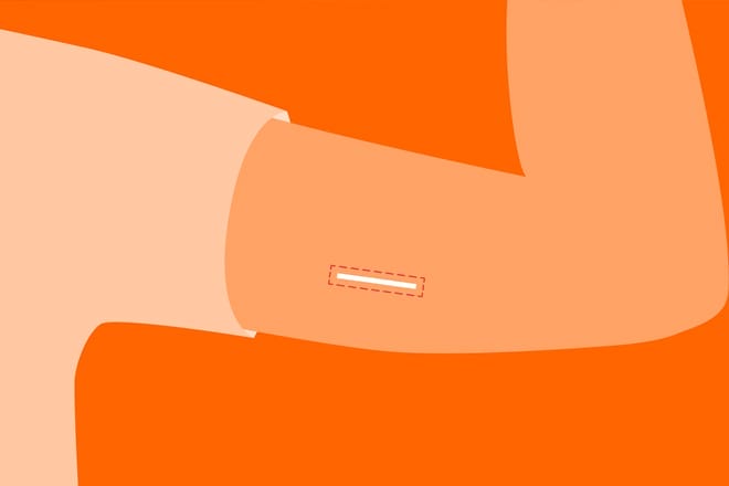 Cấy que tránh thai có gây nám da không? Có các tác dụng phụ khác không? Cấy que tránh thai có gây nám da không?