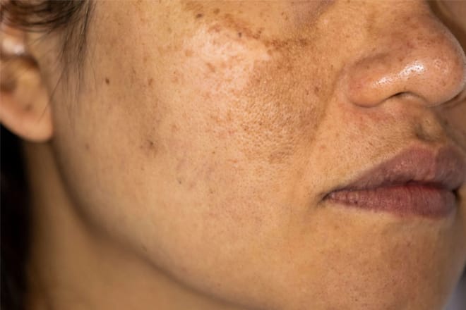 mẹ bầu bị nám da mặt