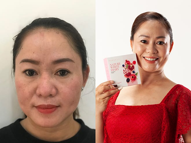 Cách trị nám da mặt bằng lòng trắng trứng gà an toàn nhất Viên uống trắng da Hanvely