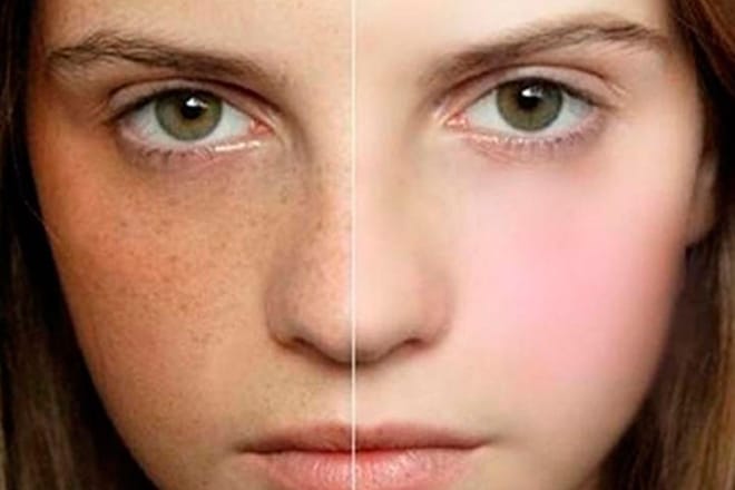 5 cách trị tàn nhang không xâm lấn hiệu quả 206761 anh dai dien cach dieu tri tan nhang hieu qua