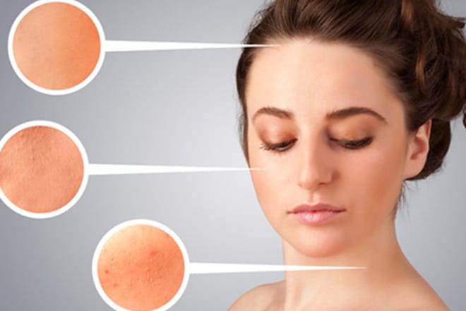 Phương pháp lăn kim trị tàn nhang có an toàn với làn da của phụ nữ Châu Á không? ưu điểm của lăn kim