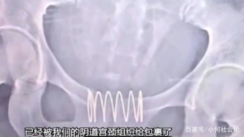 Nữ sinh nghĩ cách nhét dị vật vào amp; # 34; low regionamp; # 34 ;, bác sĩ chỉ biết ngao ngán - 1