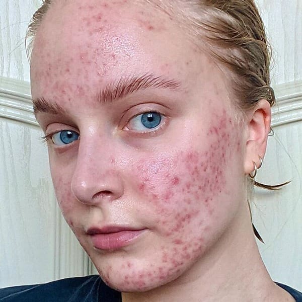 Đổi thuốc tránh thai, cô gái trẻ đau đớn nhìn mặt amp; # 34; breaknamp; # 34 ;, bác sĩ cũng sợ - 1