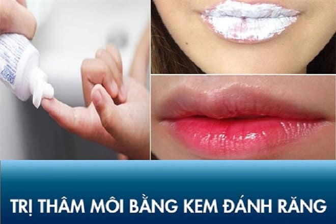 9 cách hết thâm môi nhanh chóng tại nhà chỉ sau 1 đêm làm thâm môi bằng kem đánh răng